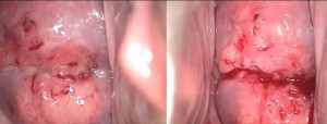 videcolposcopie-neoplasm-de-col-uterin
