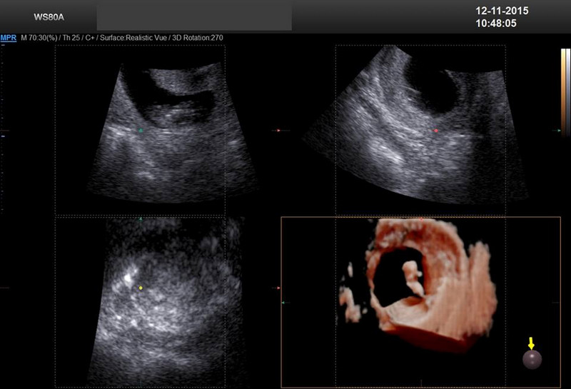 Embrion 49 zile. Ecografie 5D