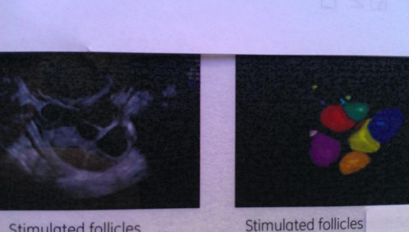 Monitorizare foliculara - infertilitate
